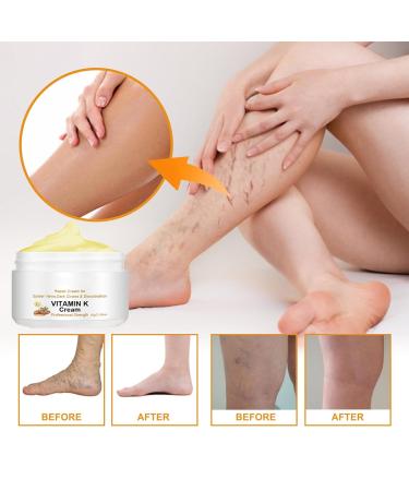 Vitamin K Cream for Varicose Veins - Miracle Cream for Spider Veins & Leg Vein Removal (1pcs) - Fast International Shipping - Buy Online on SooperMarket.com
