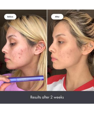 Hero Cosmetics Lightning Wand: Brightening Serum for Post-Blemish Dark Spots - Botanicals, Fragrance & Paraben Free (10ml) - Buy Online on SooperMarket.com