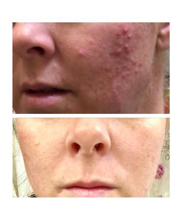 Glycolic Acid 20% Resurfacing Pads with Vitamins B5, C & E - 50 Peel Pads for Smooth Skin, Reduce Wrinkles - Buy Online on SooperMarket.com