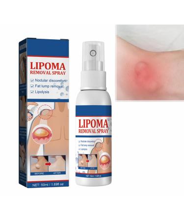 Lipoma Removal Spray Lipoma Reduction Anti-cellulite Body Shaper Spray for Men and Women 50ml