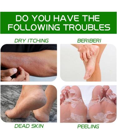 Urea Cream 40 Percent for Feet 40% Urea Cream for Cracked Heels and Dry Skin Aloe Vera Foot Cream with Tea Tree Oil Deep Moisturizing Callus Remover Nourishes Soften for Feet/Knees/Hands/Elbows - Buy Online on SooperMarket.com
