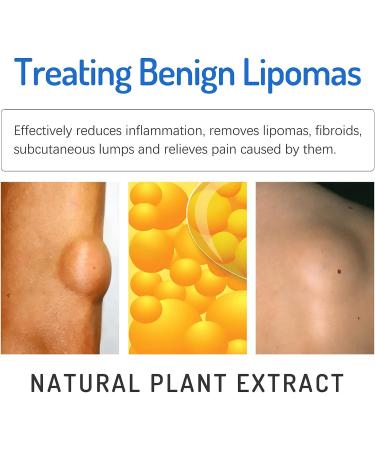Lipoma Removal Cream 20g - Natural Treatment for Lipoma Care & Discomfort - Buy Online on SooperMarket.com