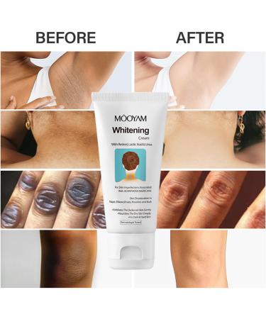 Skin Whitening Cream With Retinol Body Intimate Area Underarms Arms Knees Elbows Nourishing & Lightning Body & Neck Cream Natural Dark Spot Corrector for Private Parts(50g) - Buy Online on SooperMarket.com