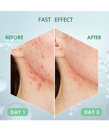 AUSLKA Pimple Patch (9 Patches) - Hydrocolloid Zit Patches for Face - Blemish & Acne Treatment Stickers - Buy Online on SooperMarket.com