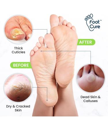 Foot Cure Exfoliator & Callus Remover Pedicure Set - Includes Foot File, Tea Tree Oil Soak, Urea Cream, USA Made - Buy Online on SooperMarket.com