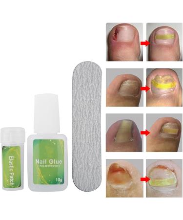 Ingrown Toenail Patch Ingrown Toenail Corrector Toenail Correction Patch Glue Toenail Patch with Elastic Gasket for Women Men Ingrown Toenail Kit (12 Pieces) - Buy Online on SooperMarket.com