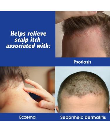 Scalpicin Max Strength Scalp Itch Treatment 1.5 oz - Effective Relief for Itchy Scalps | Buy Online Internationally - Buy Online on SooperMarket.com