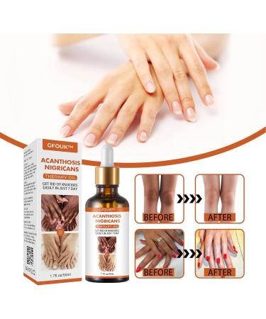 Skin Bleaching Serums | Dark Skin Permanent Whitening Lightening | Armpit Bleaching Serums for Women Supercharged Face Serums Skin Lightening Bleaching Oil Black Spot Corrector Remover for Face 2Pcs - Buy Online on SooperMarket.com