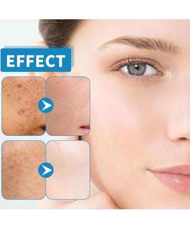Acne Serum With Plant-Based Formula Dark Spot Correcting Glow Serum Dark Spot Serum Brightening Serum Hydrating Serum Improve Redness And Blemishes Smoothing & Calming Suitable For All Skin Types - Buy Online on SooperMarket.com