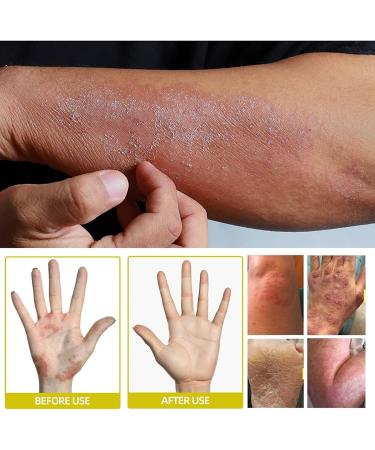 Endxedio Herbal Tinea Corporis Cream - Skin Relief & Anti-Itch Ointment (3pcs) - Buy Online on SooperMarket.com