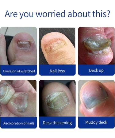 Fungal Nail Treatment For Toenails - Extra Strong Nail Fungus Treatment for Toenail - Toe Nail Fungal Treatment - Anti-Fungal Nail Repair Treatment with Nail File and Nail Brush - Buy Online on SooperMarket.com