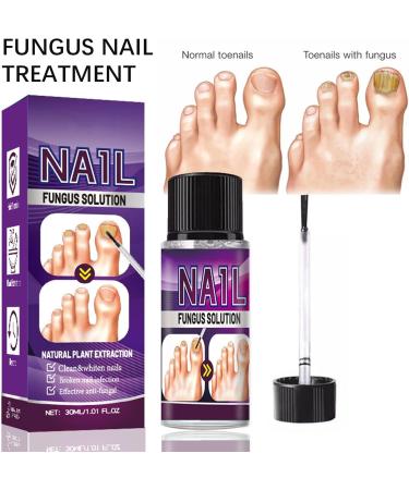Fungal Nail Treatment 30ml Extra Strong Nail Fungus Treatment for Toenail and Fingernail Premium Fungal Nail Eliminator Anti fungus Nail Repair and Strengthen Fix & Renew Damaged Broken Nails - Buy Online on SooperMarket.com