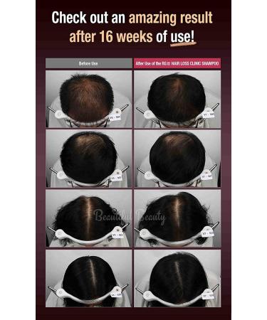 RGIII Premium Red Ginseng Hair Loss Prevention Shampoo & Treatment Set - Buy Online on SooperMarket.com