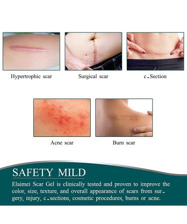 Silicone Scar Sheets Roll (1.6 x 120) for Scar Removal - Professional Grade Strips for Surgery, C-Section, Burn, Acne, Keloid - Safe & Reusable - Buy Online on SooperMarket.com