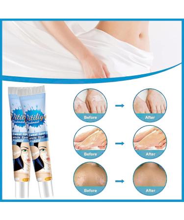MIELIKKI Vitiligo Cream | Reduce White Spots & Enhance Skin Pigmentation | Natural Vitiligo Care Cream for All Skin Types - Buy Online on SooperMarket.com