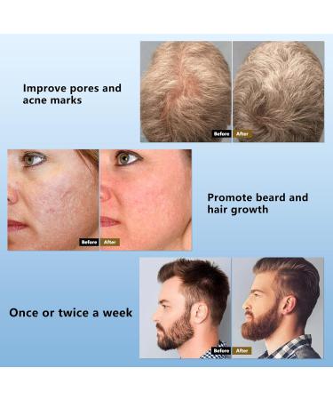 Derma Roller Beard Growth Kit - 540 Titanium Microneedling Roller for Face & Beard Growth - Includes Travel Case - 0.5mm - Buy Online on SooperMarket.com