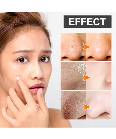 Peel Off Blackhead Removal Mask - Acne Treatment Pore Cleansing Cream & Nose Strips - 30ml + 60 Pcs for Clear Skin - Buy Online on SooperMarket.com