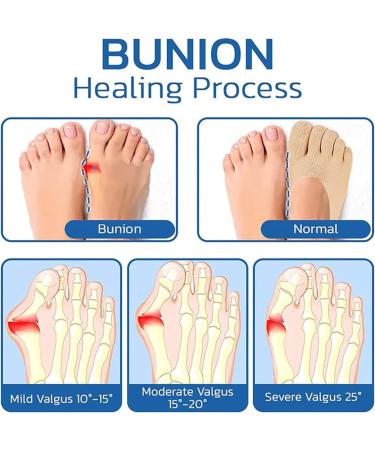 Orthopedic Bunion Relief Socks - Toe Alignment & Compression for Bunions - 5/10 Pairs - Buy Online on SooperMarket.com