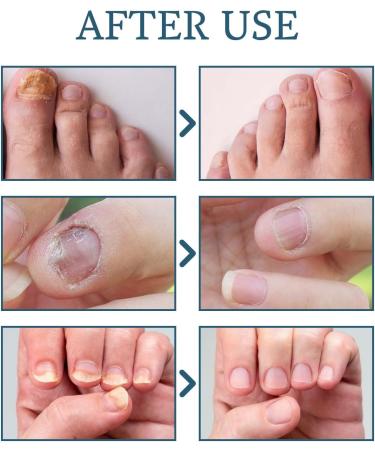 Fungal Nail Treatment - Extra Strong Nail Fungus Treatment for Toenail and Fingernail - Fungal Nail Eliminator Anti fungus Nail Repair and Strengthen Fix & Renew Damaged Broken Nails 30ml - Buy Online on SooperMarket.com