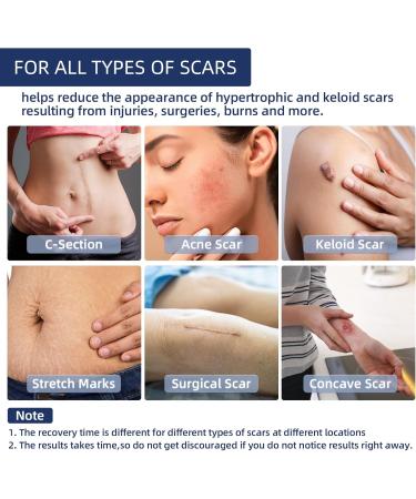 Silicone Scar Tape for Surgical Scars - Extra Long Scar Sheets for C-Section (59 in x 1.5 in) - Buy Online on SooperMarket.com