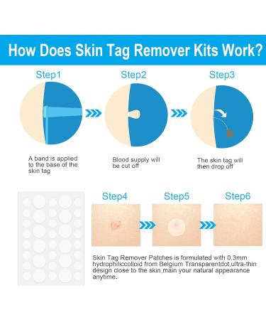 Painless 2-in-1 Skin Tag Removal Kit for Micro to Large Skin Tags (1-9mm) - Safe & Easy DIY Tool for Home Use - Buy Online on SooperMarket.com