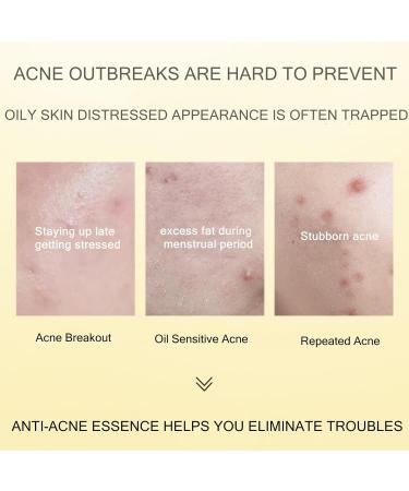 Gentle Acne Serum for Face Acne Treatment Essence Relief Pimple Pigmentation Blackhead Brighten Shrink Smooth Skin Redness Relief Face Acne Spot Treatment Repair Skin for Acne Skin - Buy Online on SooperMarket.com