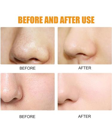 10pcs Hydrocolloid Blackhead Removal Patches | Deep Cleansing Pore Strips for Face, Nose, and Pores | Dermatologist Approved | Overnight Use - Buy Online on SooperMarket.com