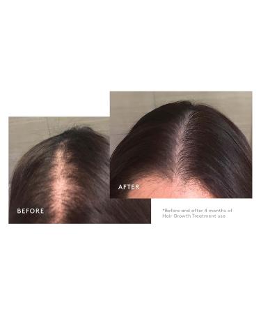 Virtue Flourish Hair Growth Regimen for Women - Minoxidil 5% Foam for Fine & Thinning Hair | Sulfate Free & Color Safe - International Shipping Available - Buy Online on SooperMarket.com