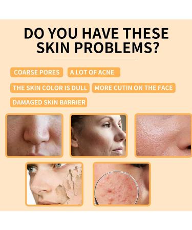 Glycolic Acid 7% Toning Solution Hydrating Toner for Face Glycolic Acid Skin Toner Smoothing Face Toner Facial Exfoliation for Blemishes and Acne Facial Moisturizer-Repair Damage Skin (100ml) - Buy Online on SooperMarket.com
