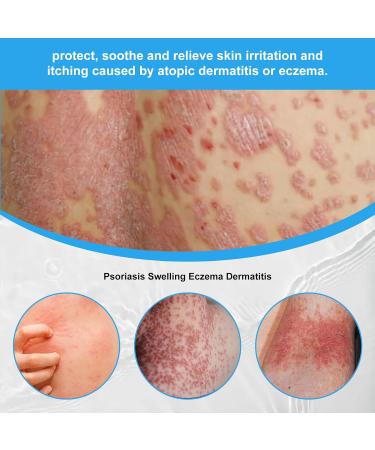 ZJchao 2pcs 30ml Psoriasis Relief Solution Spray - Effective Itch Relief Treatment for Skin, Hand, and Foot - Buy Online on SooperMarket.com