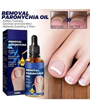 German Toenailcare Removal Paronychia Oil - Repair Damaged Discolored Thick Nails - 2 Pcs - Buy Online on SooperMarket.com