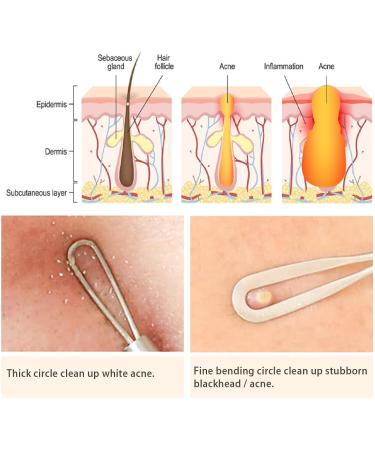 ME MAXEQUIP Blackhead Remover Pimple Popper Blemish Comedone Extractor Acne Tool Pimple Spot Popper Komedon Double Side Soft Touch and No-Slip Skincare for Whitehead Removal Stainless Steel - Buy Online on SooperMarket.com
