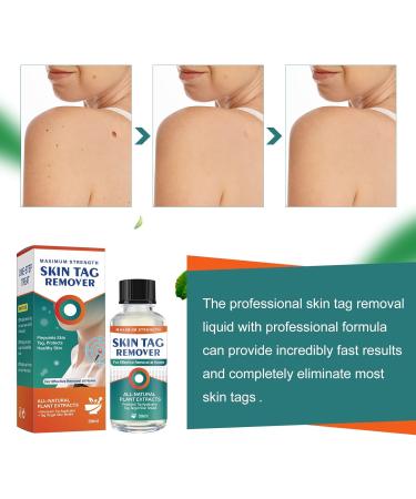 Skin-Tag-Remover Kit Remover for Verruca-Treatment - 30ml - Buy Online on SooperMarket.com