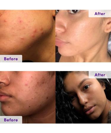 NxN Acne Treatment Kit - 4-Step Clear Skin System with Salicylic Acid, Probiotics, Sulfer & Natural Retinols - Control Blemishes and Breakouts - Face Care Solution Set for All Skin Types - Buy Online on SooperMarket.com
