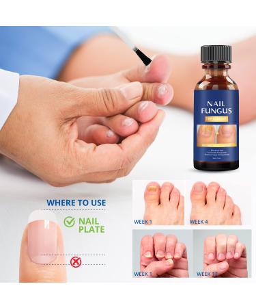 Extra Strength Toe Nail Fungus Treatment - Effective Nail Repair Solution for Healthy Nails - Buy Online on SooperMarket.com