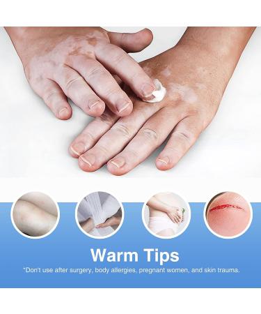 UpdateClassic Vitiligo Cream | Natural Vitiligo Treatment for Skin | Reduce White Spots & Improve Pigmentation | Easy to Use | Blue/Vitiligo - Buy Online on SooperMarket.com