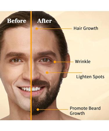 Incellice 192 Titanium Needles Derma Roller for Hair Growth in Women and Men 1.0 - Buy Online on SooperMarket.com