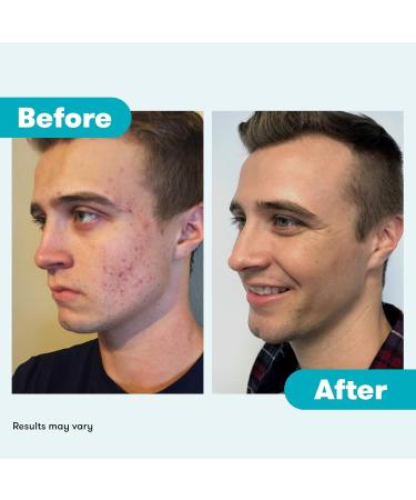 Proactiv 3 Step Acne Treatment - Benzoyl Peroxide Face Wash Repairing Acne Spot Treatment For Face And Body Exfoliating Toner - 30 Day Complete Acne Skin Care Kit - Buy Online on SooperMarket.com