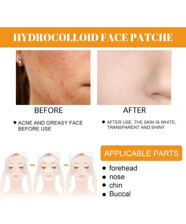 Pimple Patches for Face Hydrocolloid Surface Patches for Forehead Nose Chin and Cheeks Large Acne Treatment Patches for Pimple Extraction and Clean Pores Hydrocolloid Acne Patches for Acne Skin - Buy Online on SooperMarket.com
