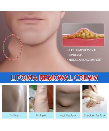 Lump-Free Lipoma Removal Ointment - Natural Vegetable Formula for Anti-Swelling & Skin Care - Hyper Havoc (White, One Size) - Buy Online on SooperMarket.com