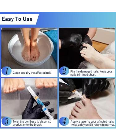 XIFEPFR Toenail Repair Pen - Nail Fingernail Repair Pen for Thick  Broken  Discolored Nails - Restores Healthy Strong Nails - 4PCS - Buy Online on SooperMarket.com