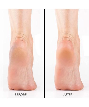 Extra Strength Callus Remover Gel 8oz - Salon Grade Pedicure Supplies for Rough, Dry Skin - Heavy Duty Foot Callus Remover with Cool Mint - Professional Home Treatment - Buy Online on SooperMarket.com