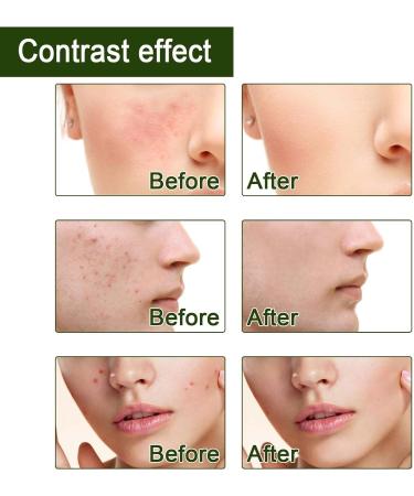 Trendyfave Tea Tree Essential Oils Tea Tree Oil for Skin Anti-Pimples and Acne Moisturizer and Brighten Skin. Tea Tree Oil for Diffuser Humidifier DIY Home Office. Tea Tree Face Oil-10ml - Buy Online on SooperMarket.com