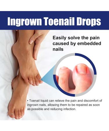 Ingrown Toenail Treatment - 30ML Ingrown Toenail Correction Drops - Nail Helper Ingrowth Toenail Treatment Oil - Trimming Toenail Softening Drops - Nail Fungal Treatment - Buy Online on SooperMarket.com