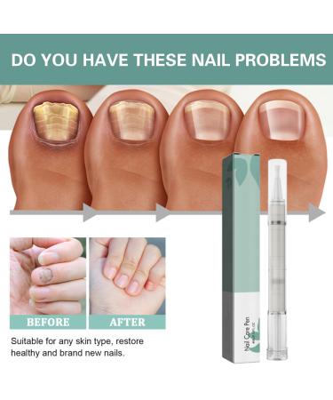 4-Piece Nail Care Pen Set with Tea Tree Oil Vitamin E & Aloe Vera - Well-Groomed Fingernails & Toenails - Includes Nail File - Green - Buy Online on SooperMarket.com
