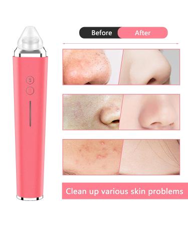 WiFi Blackhead Remover Pore Vacuum with 5.0 Megapixels HD Camera | Electric Blackhead Suction Tool with 6 Suction Heads | USB Rechargeable Pimple Acne Comedone Extractor Kit - Pink - Buy Online on SooperMarket.com