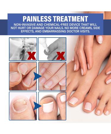 NailPro Nail Fungus LED Light Therapy Device Nail Fungus Laser Nail Fungus Treatment Home Use Nail-Fungus Remover for Toenail Fingernails & Onychomycosis (A01) - Buy Online on SooperMarket.com