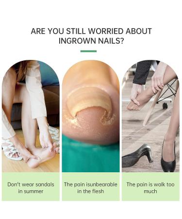 Ingrown Toenail Treatment Kit - 50 Pcs Patches, Corrector Strips, Nail Lifter | Professional & Painless Solution - Buy Online on SooperMarket.com
