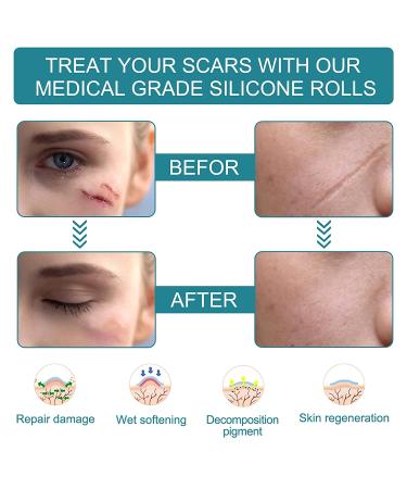 Medical Grade Silicone Scar Tape Roll (1.6 x 60) for Scar Removal - Professional Silicone Strips for Surgery, C-Section, Acne, Burn and Keloid - Safe & Reusable - 1.5M - Buy Online on SooperMarket.com