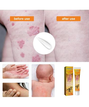 Bee Venom Cream for Psoriasis Cream Bee Venom Cream Psoriasis Treatment New Zealand Bee Venom Chinese Herbal Cream for Psoriasis Bee Venom Psoriasis Soothing Itching 20g (2) - Buy Online on SooperMarket.com